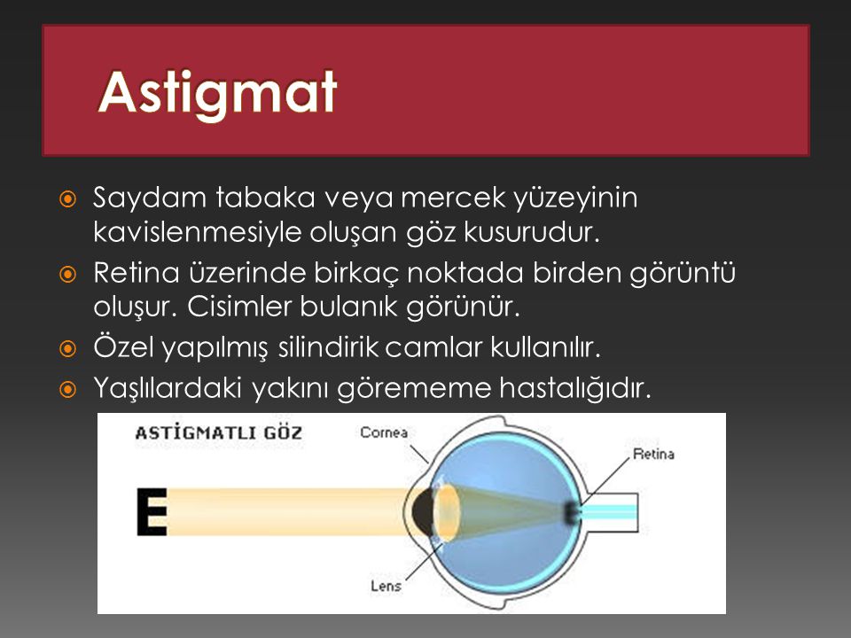 Astigmat Saydam tabaka veya mercek yüzeyinin kavislenmesiyle oluşan göz kusurudur.