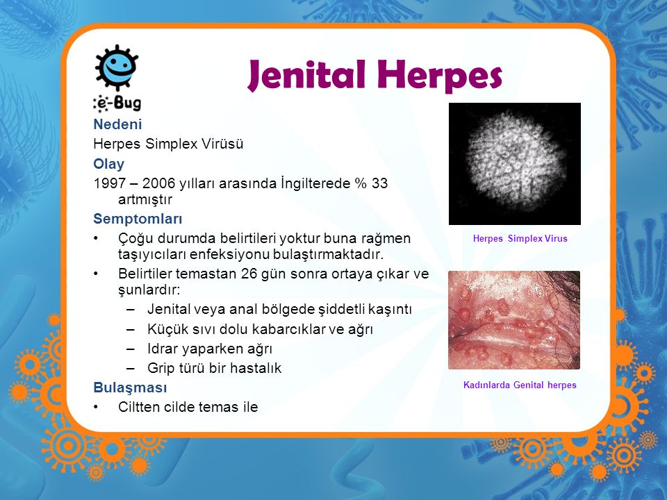 Kadınlarda Genital herpes