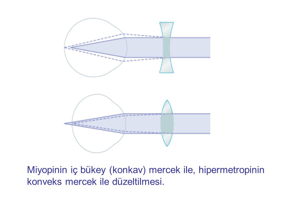 Miyopinin iç bükey (konkav) mercek ile, hipermetropinin konveks mercek ile düzeltilmesi.