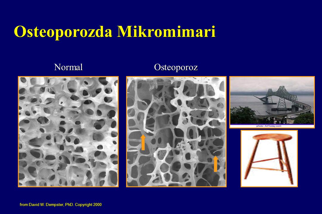Osteoporozda Mikromimari