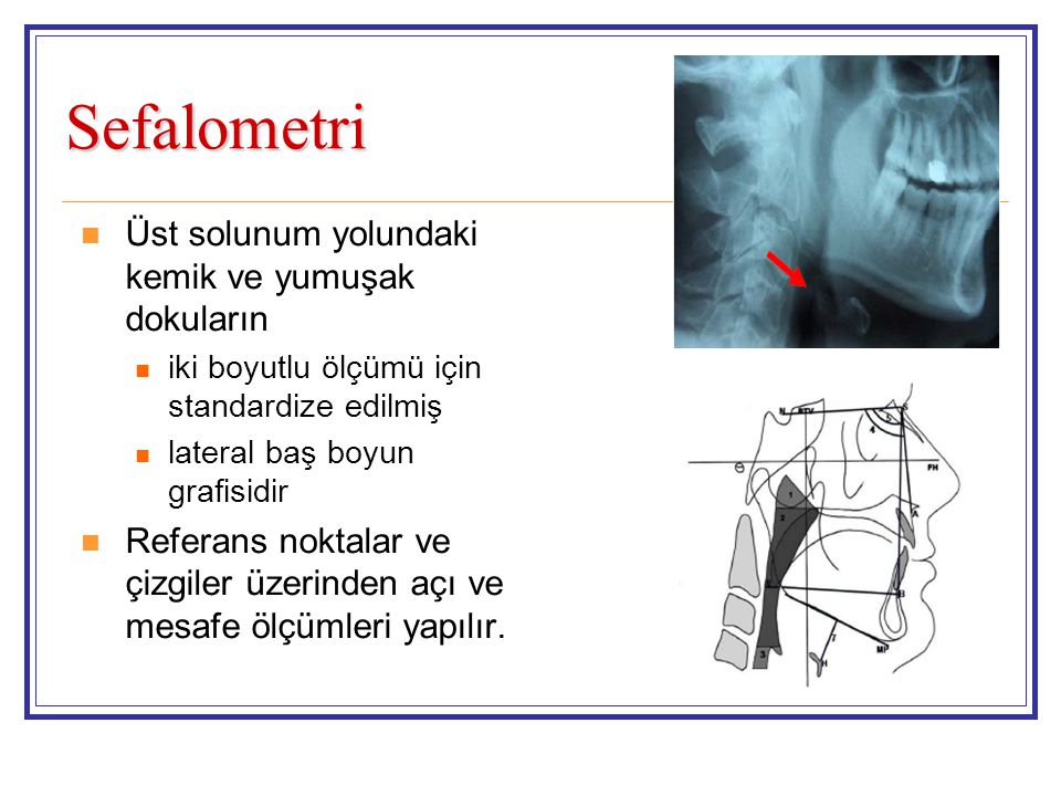 Sefalometri Üst solunum yolundaki kemik ve yumuşak dokuların