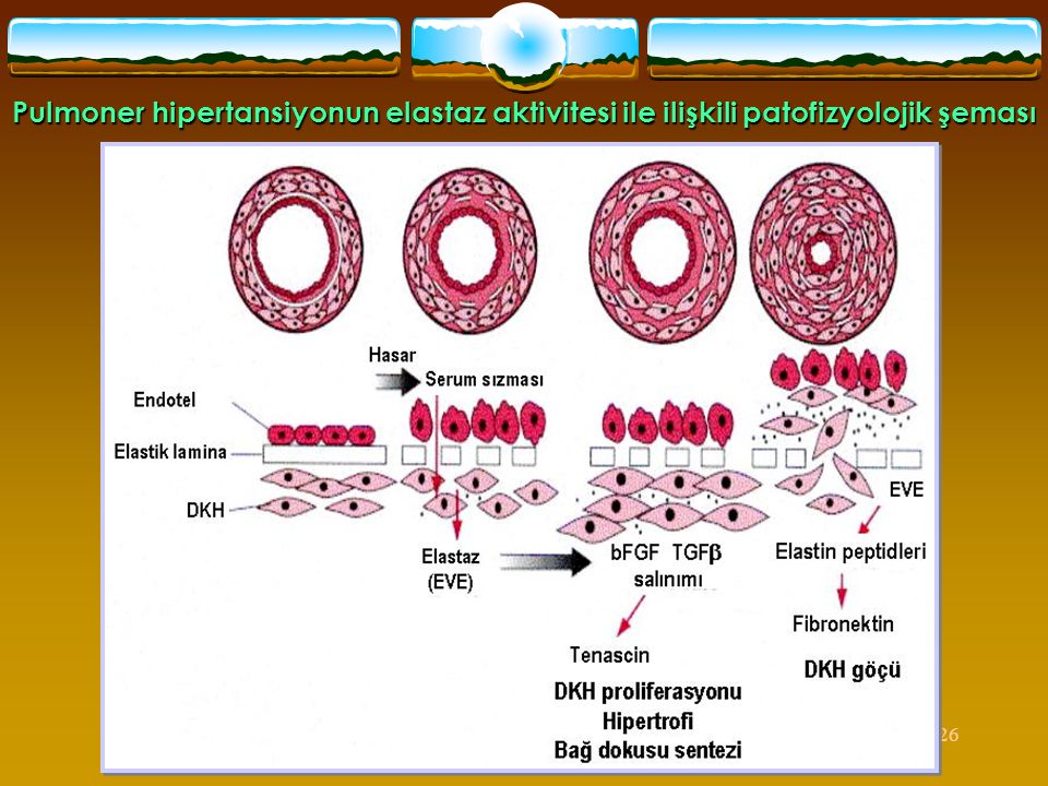 Pulmoner hipertansiyonun elastaz aktivitesi ile ilişkili patofizyolojik şeması