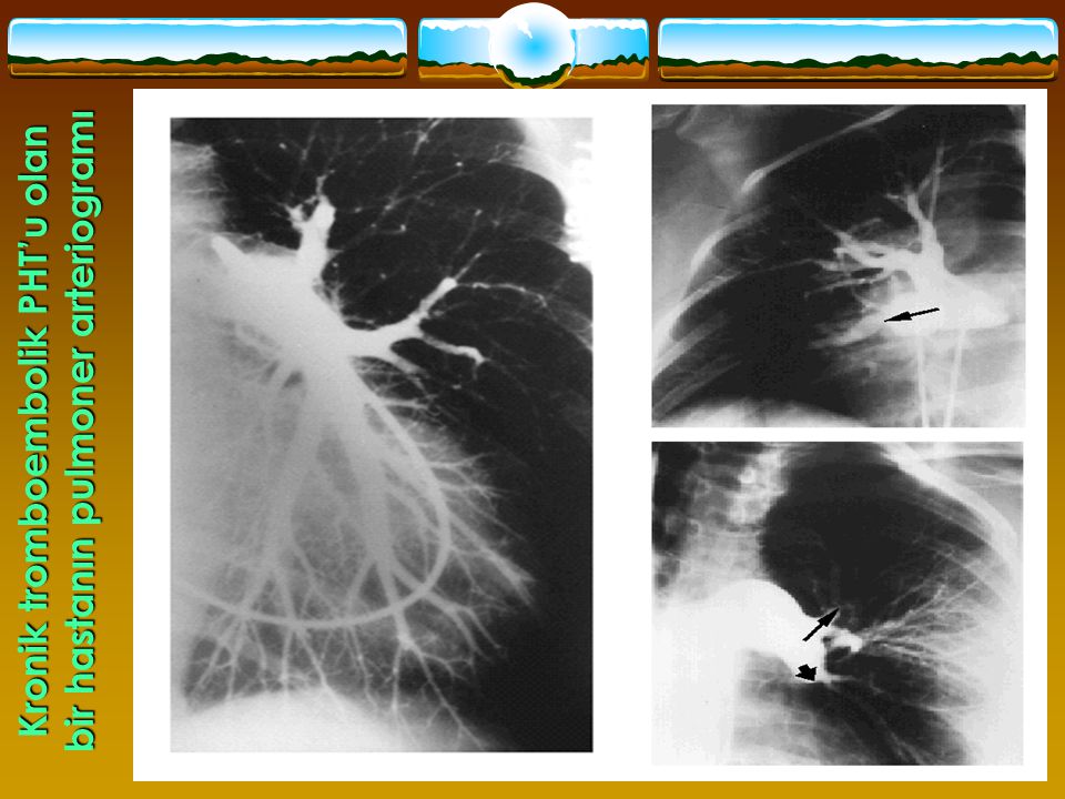 Kronik tromboembolik PHT’u olan bir hastanın pulmoner arteriogramı