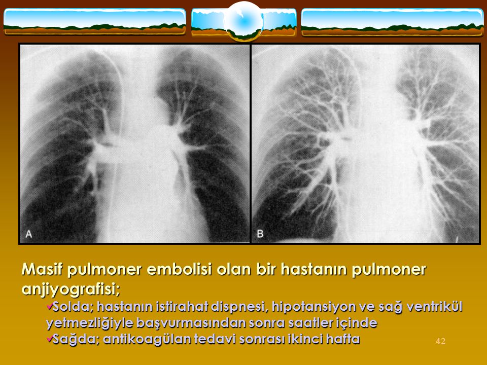Masif pulmoner embolisi olan bir hastanın pulmoner anjiyografisi;