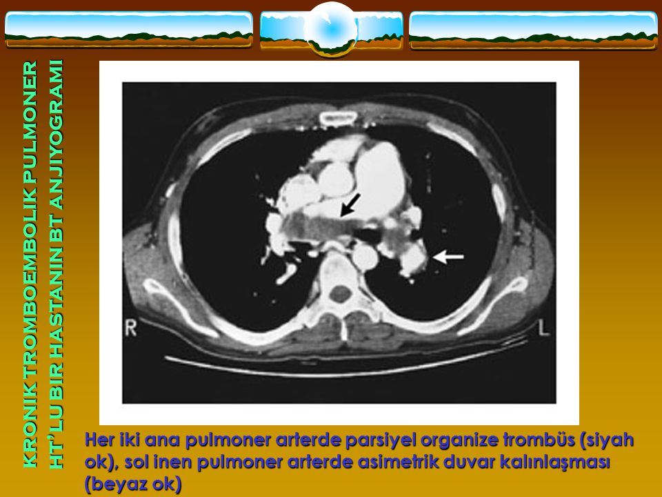 kronik tromboembolik pulmoner ht’lu bir hastanın bt anjiyogramı