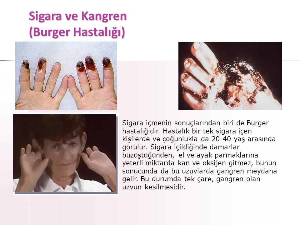 Sigara ve Kangren (Burger Hastalığı)‏