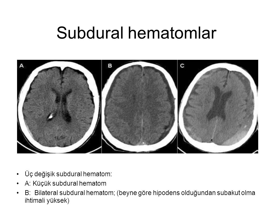 Hominick Hematoma