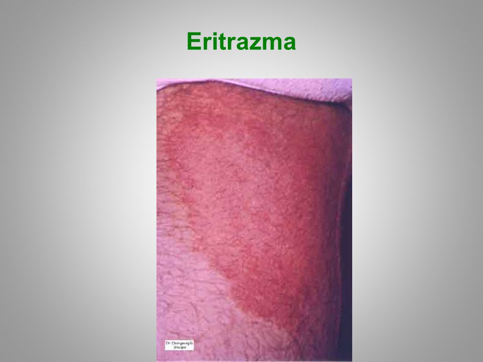 Eritrazma