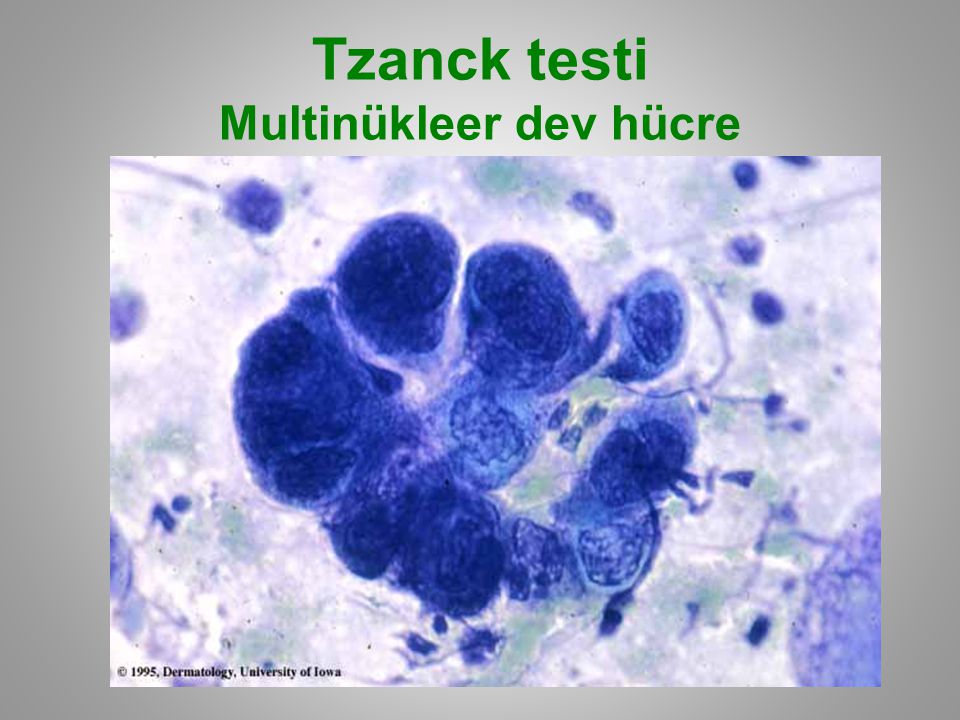 Tzanck testi Multinükleer dev hücre