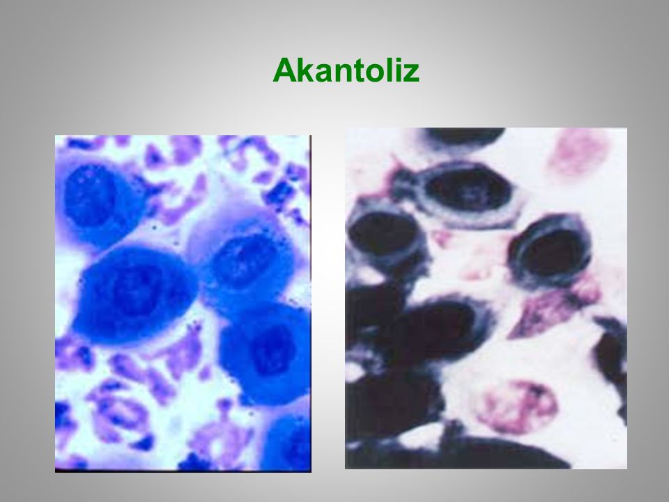 Akantoliz
