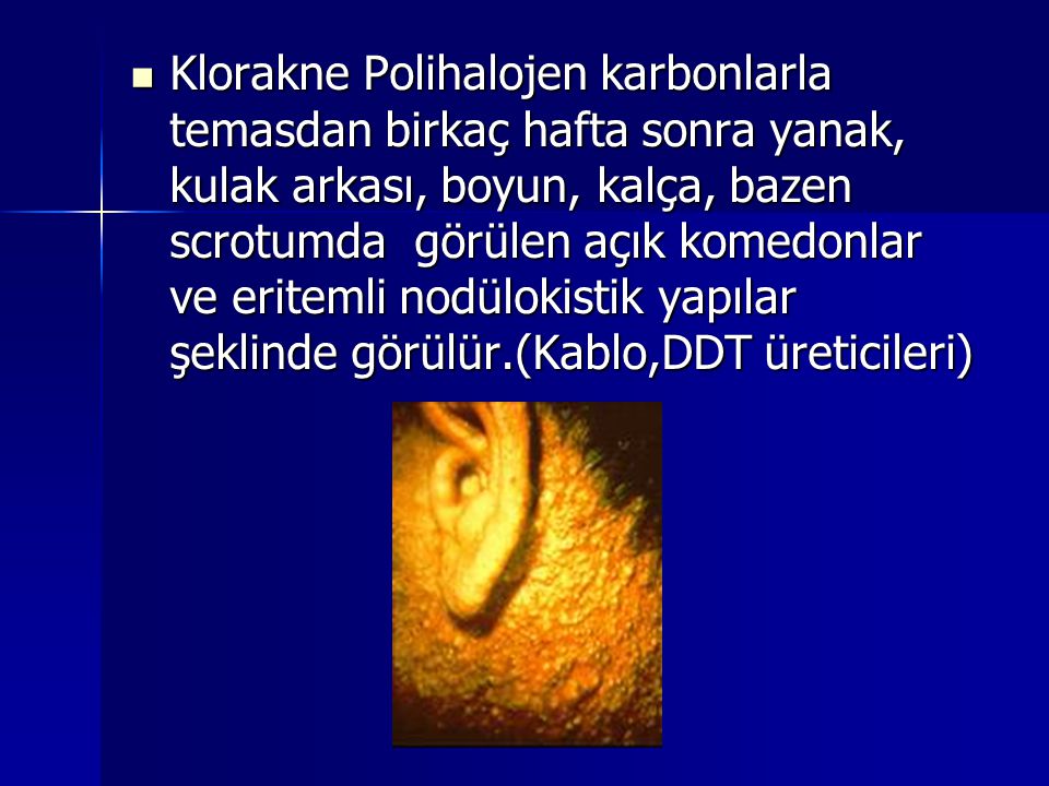 Klorakne Polihalojen karbonlarla temasdan birkaç hafta sonra yanak, kulak arkası, boyun, kalça, bazen scrotumda görülen açık komedonlar ve eritemli nodülokistik yapılar şeklinde görülür.(Kablo,DDT üreticileri)