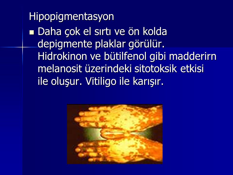 Hipopigmentasyon