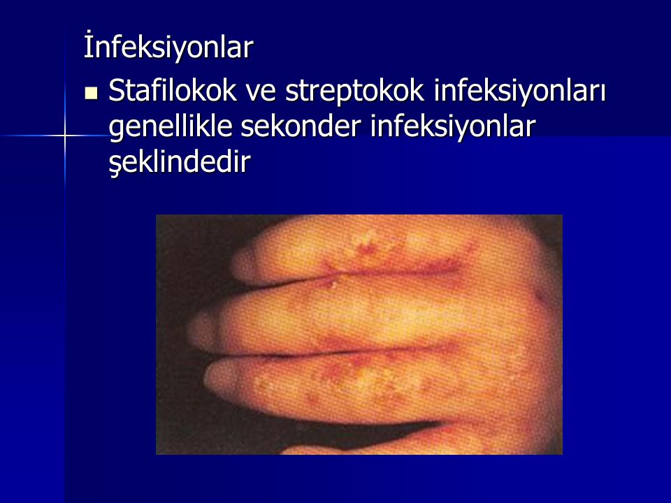 İnfeksiyonlar Stafilokok ve streptokok infeksiyonları genellikle sekonder infeksiyonlar şeklindedir