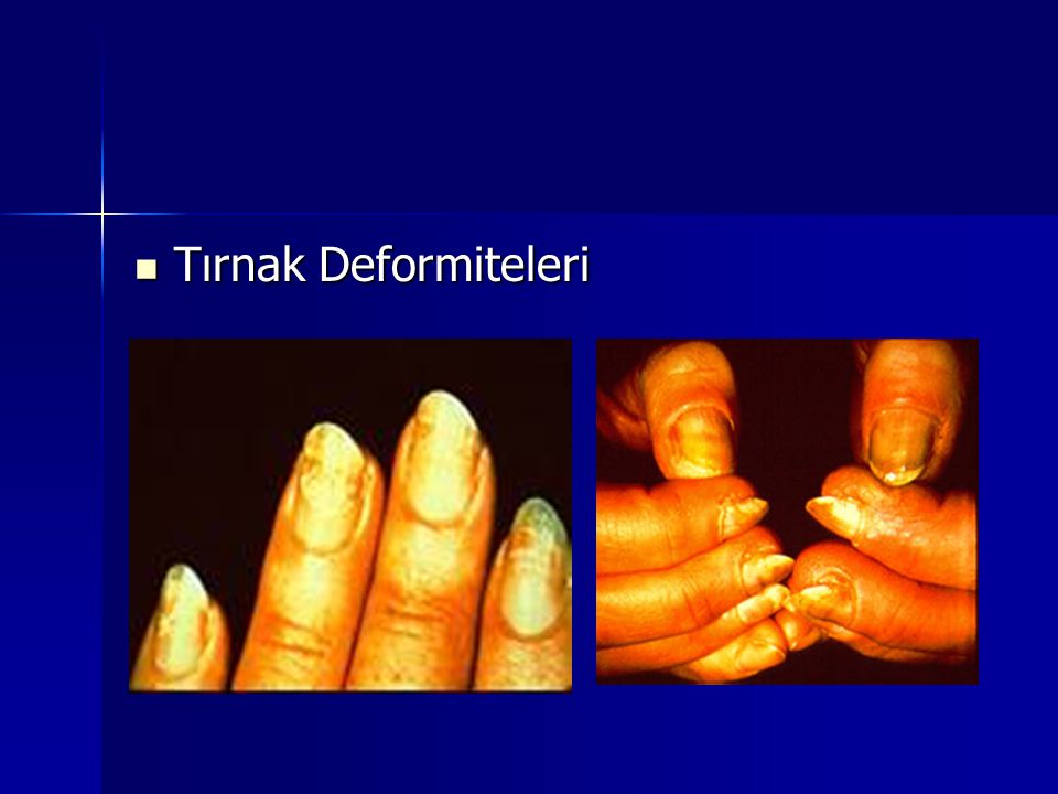 Tırnak Deformiteleri