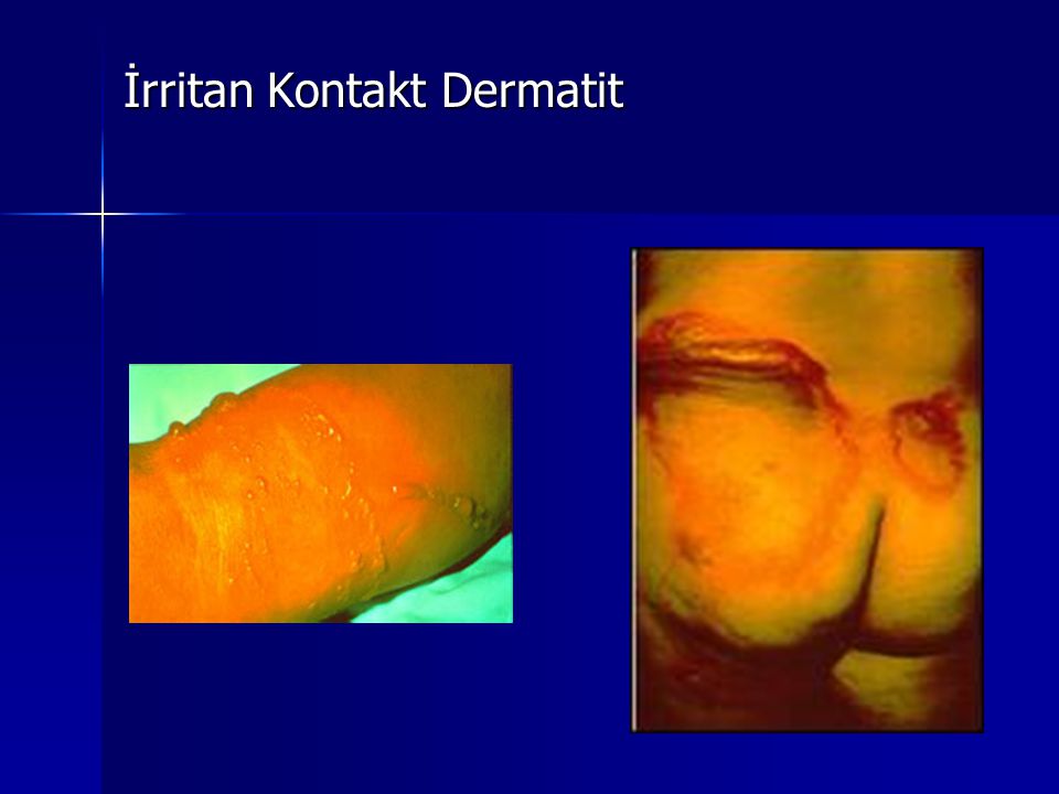İrritan Kontakt Dermatit