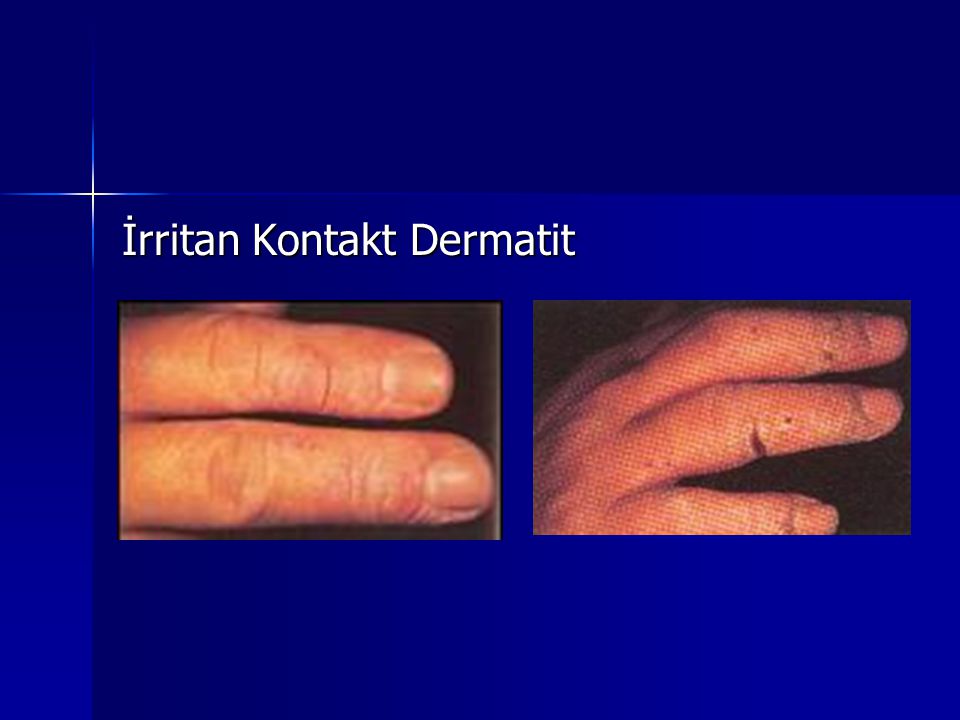 İrritan Kontakt Dermatit