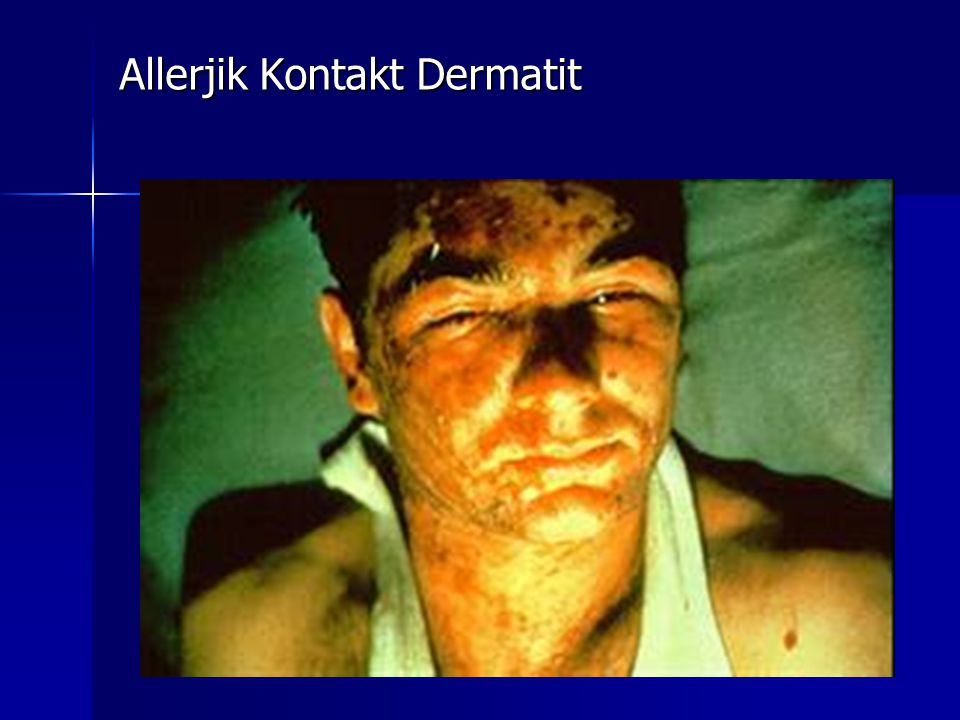 Allerjik Kontakt Dermatit