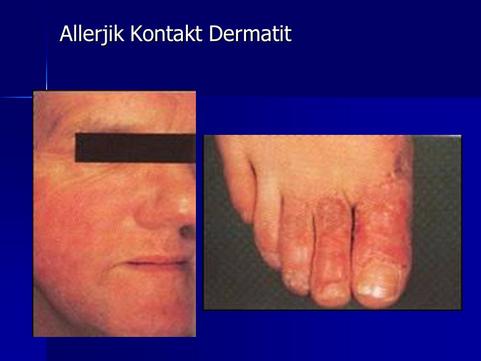 Allerjik Kontakt Dermatit