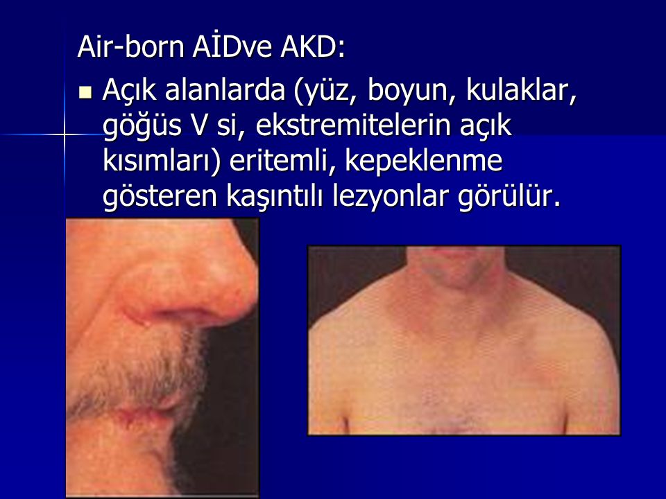 Air-born AİDve AKD: