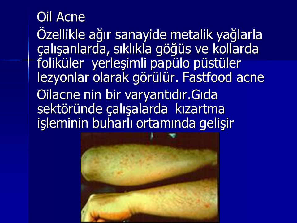 Oil Acne
