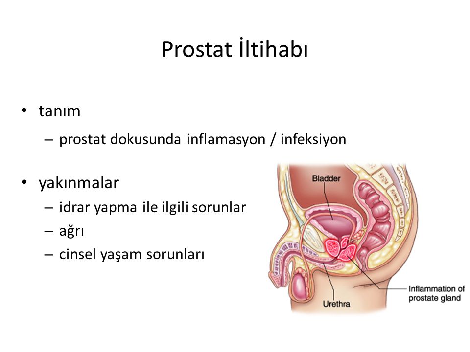Prostat İltihabı tanım yakınmalar