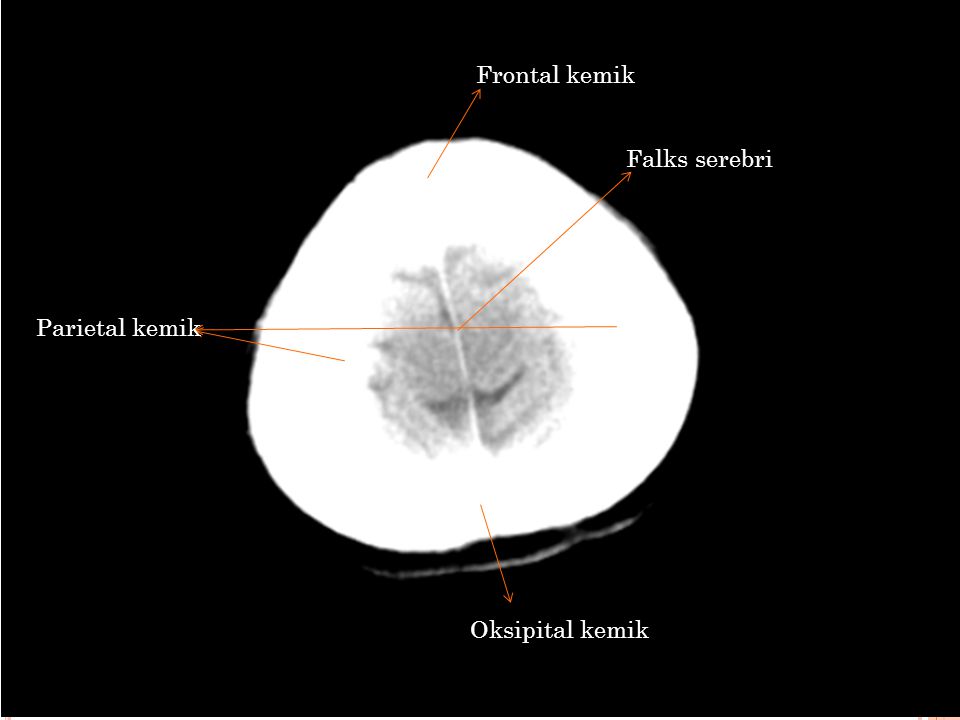 Frontal kemik Falks serebri Parietal kemik Oksipital kemik