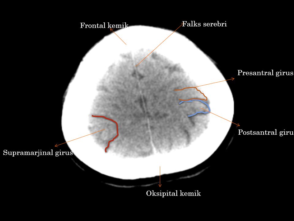 Frontal kemik Falks serebri Presantral girus Postsantral girus Supramarjinal girus Oksipital kemik