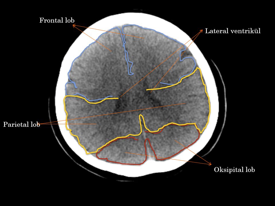Frontal lob Lateral ventrikül Parietal lob Oksipital lob
