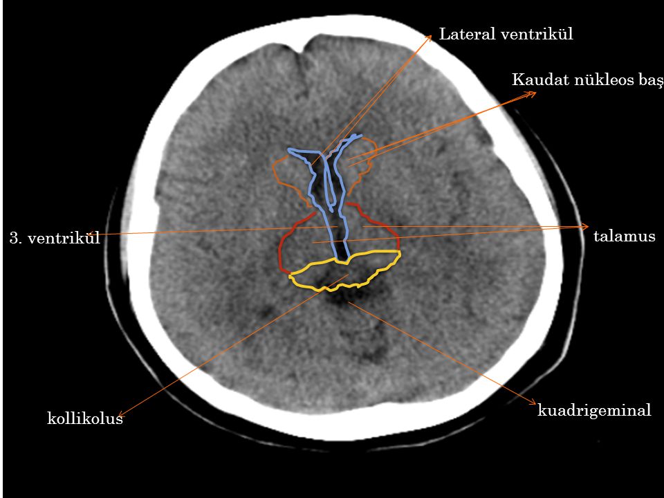 Lateral ventrikül Kaudat nükleos başı 3. ventrikül talamus kuadrigeminal kollikolus