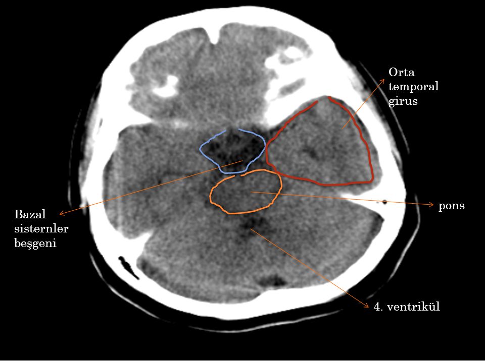 Orta temporal girus pons Bazal sisternler beşgeni 4. ventrikül