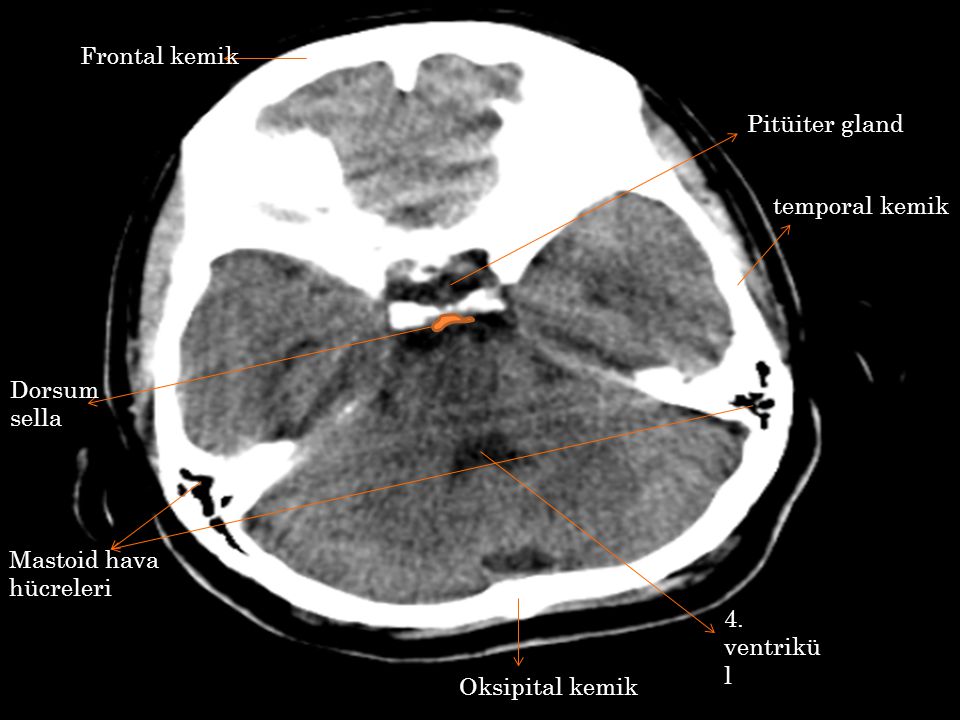 Frontal kemik Pitüiter gland. temporal kemik. Dorsum sella. Mastoid hava hücreleri. 4. ventrikül.
