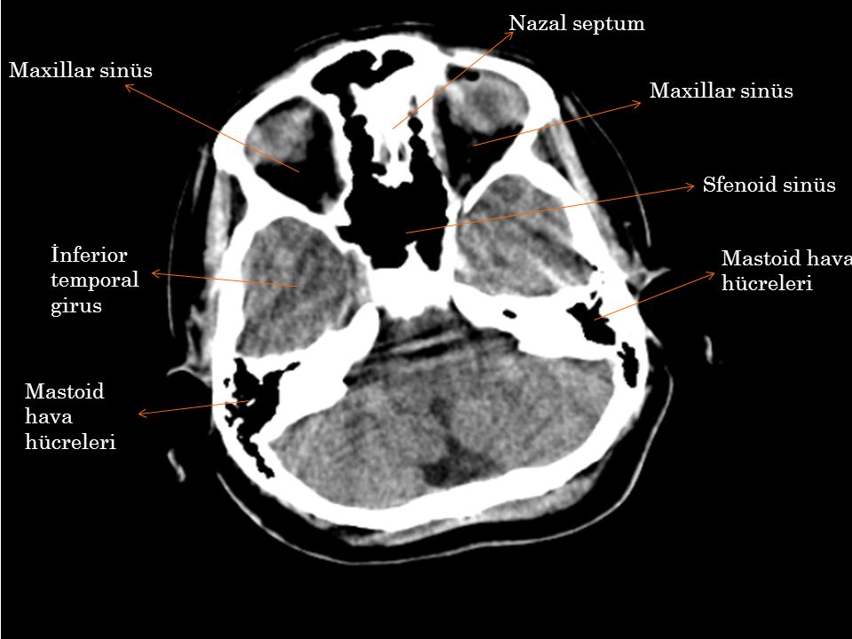 Nazal septum Maxillar sinüs. Maxillar sinüs. Sfenoid sinüs. İnferior temporal girus. Mastoid hava hücreleri.