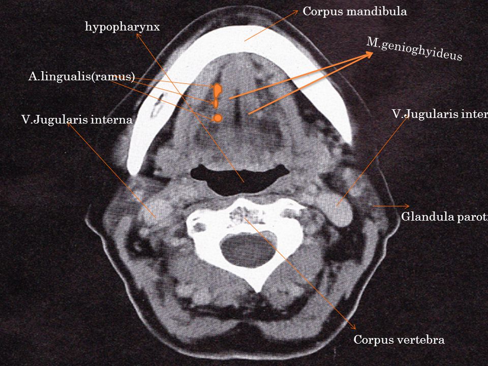 Corpus mandibula hypopharynx. M.genioghyideus. A.lingualis(ramus) V.Jugularis interna. V.Jugularis interna.