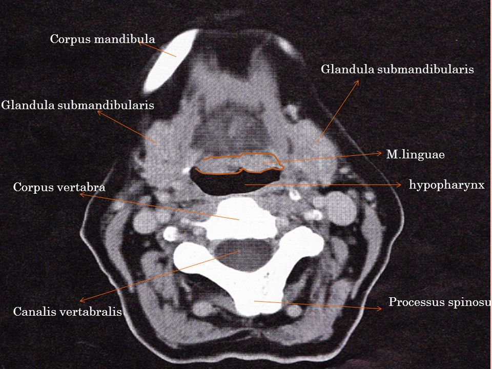 Corpus mandibula Glandula submandibularis. Glandula submandibularis. M.linguae. Corpus vertabra.