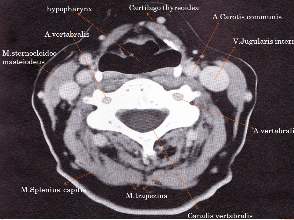 hypopharynx Cartilago thyreoidea. A.Carotis communis. A.vertabralis. V.Jugularis interna. M.sternocleideomasteiodeus.
