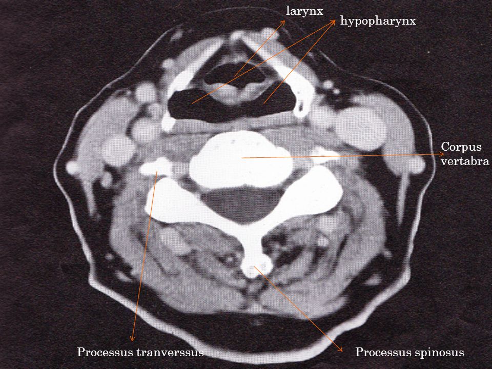 larynx hypopharynx Corpus vertabra Processus tranverssus Processus spinosus