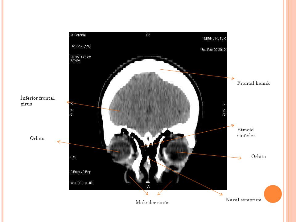 Frontal kemik İnferior frontal girus Etmoid sinüsler Orbita Orbita Nazal semptum Maksiler sinüs