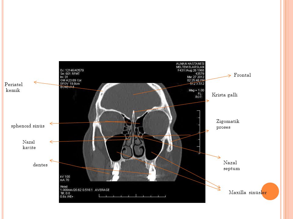 Frontal Periatel kemik Krista galli Zigomatik proses sphenoıd sinüs