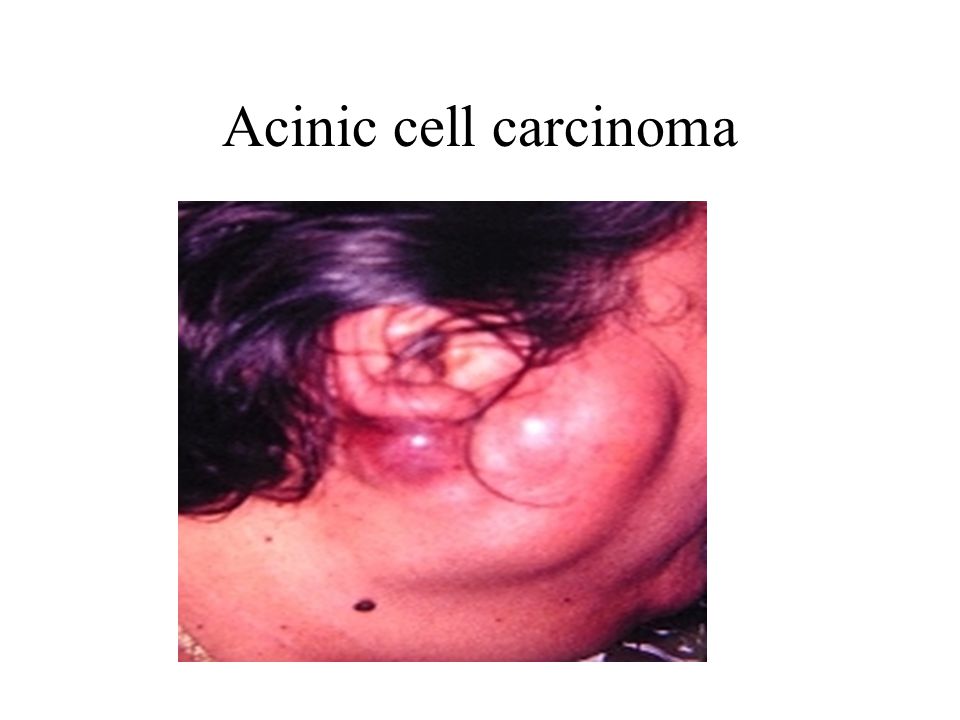 Acinic cell carcinoma