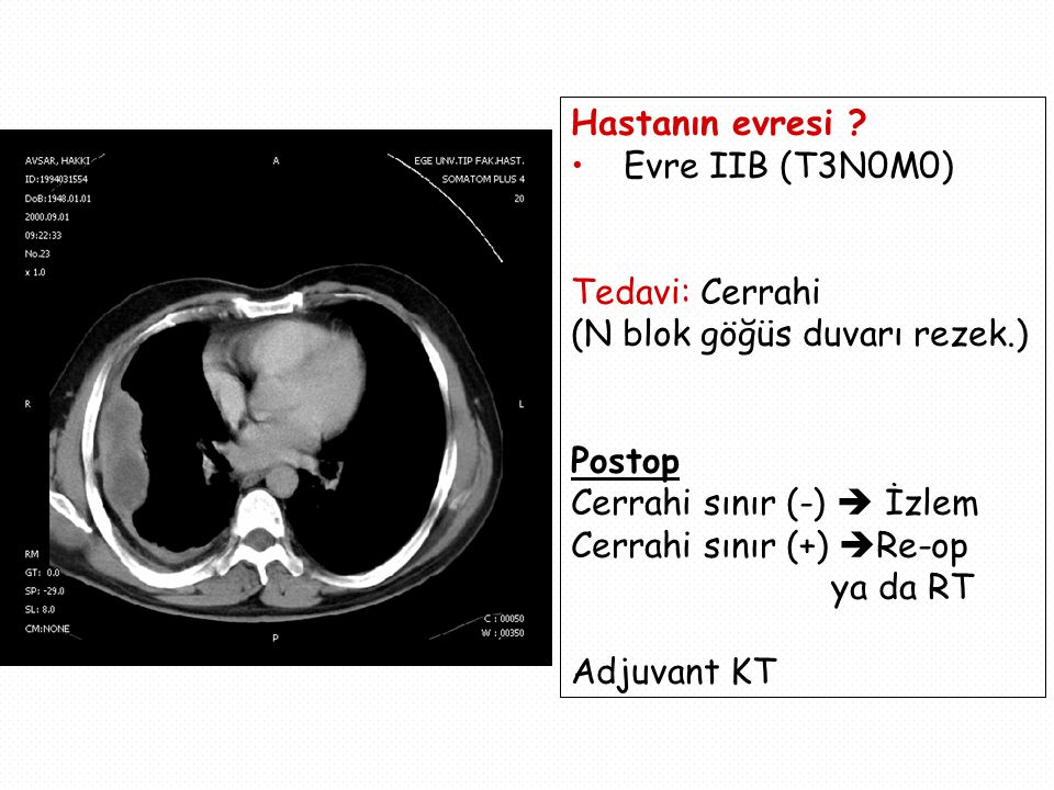 Hastanın evresi Evre IIB (T3N0M0) Tedavi: Cerrahi. (N blok göğüs duvarı rezek.) Postop. Cerrahi sınır (-)  İzlem.