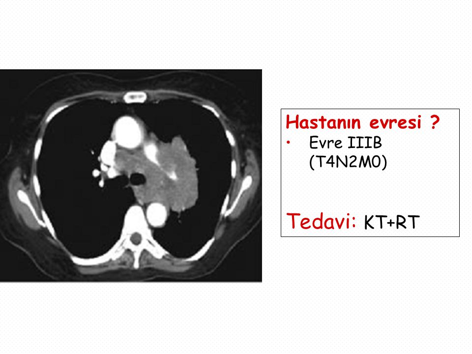 Hastanın evresi Evre IIIB (T4N2M0) Tedavi: KT+RT