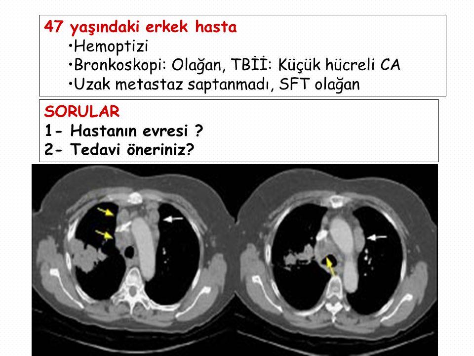 47 yaşındaki erkek hasta Hemoptizi. Bronkoskopi: Olağan, TBİİ: Küçük hücreli CA. Uzak metastaz saptanmadı, SFT olağan.