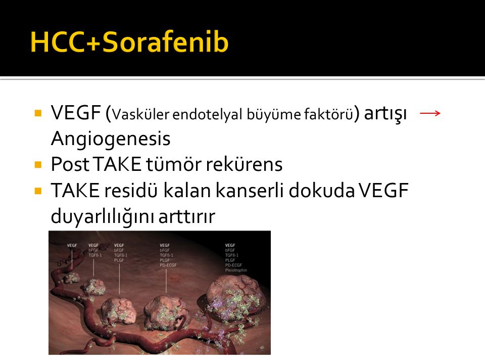 HCC+Sorafenib VEGF (Vasküler endotelyal büyüme faktörü) artışı Angiogenesis. Post TAKE tümör rekürens.