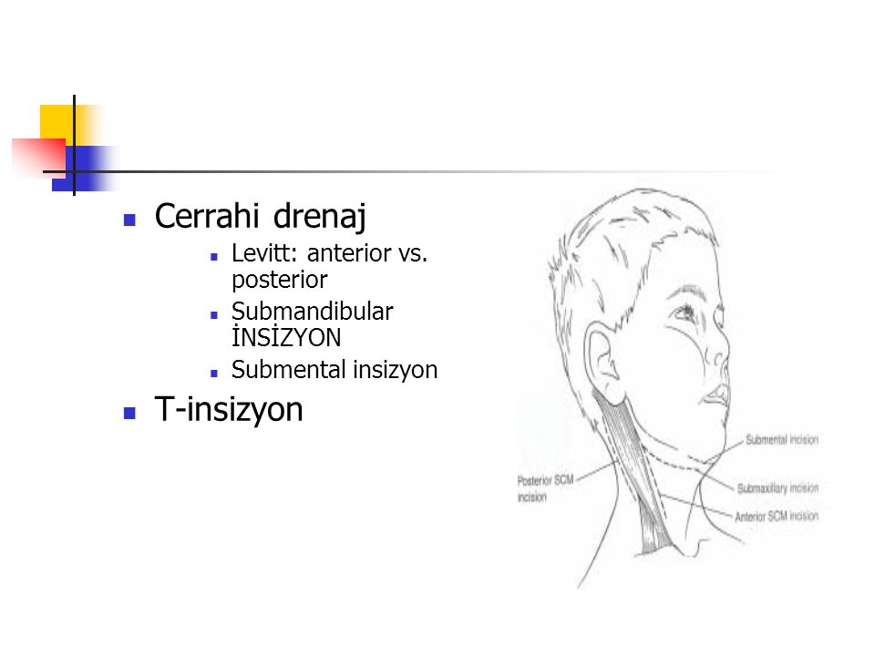 Cerrahi drenaj T-insizyon Levitt: anterior vs. posterior