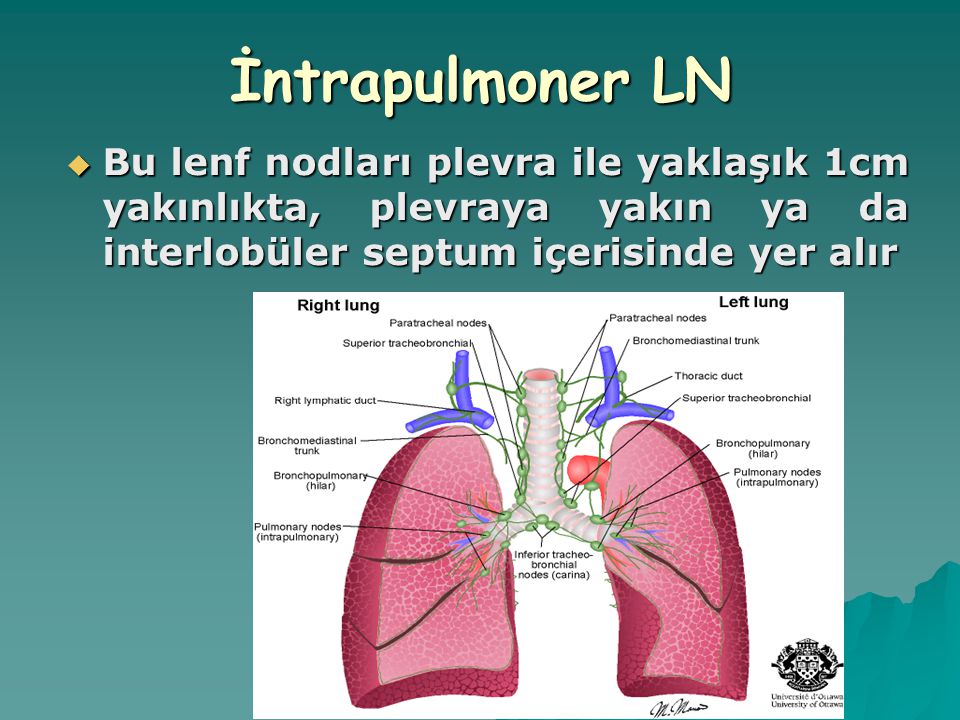 İntrapulmoner LN Bu lenf nodları plevra ile yaklaşık 1cm yakınlıkta, plevraya yakın ya da interlobüler septum içerisinde yer alır.