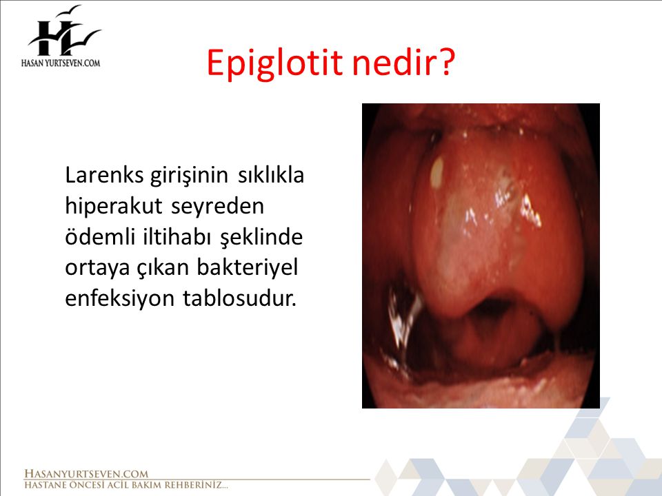 Epiglotit nedir Larenks girişinin sıklıkla hiperakut seyreden ödemli iltihabı şeklinde ortaya çıkan bakteriyel enfeksiyon tablosudur.