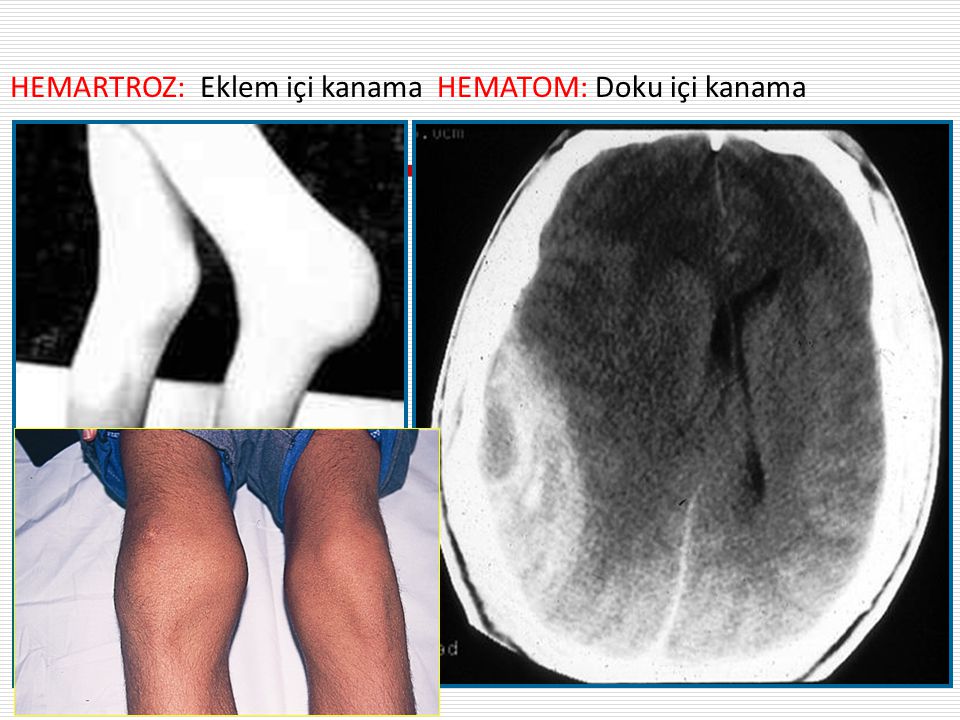 Hominick Hematoma