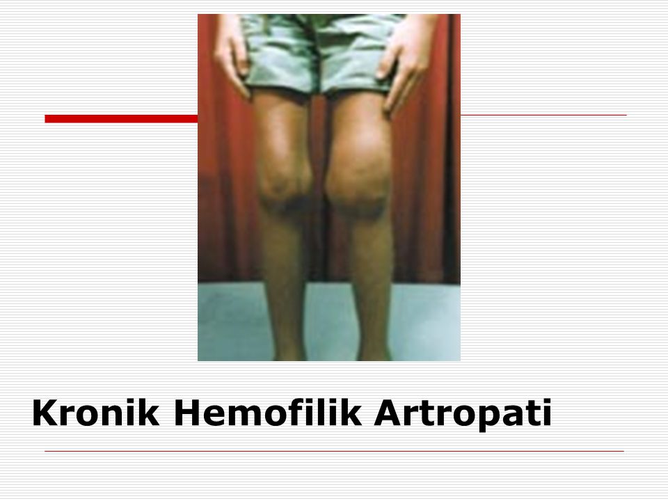 Kronik Hemofilik Artropati