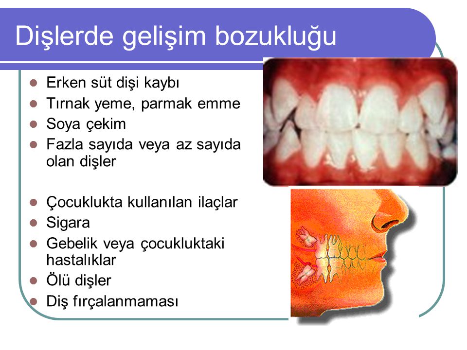 Dişlerde gelişim bozukluğu