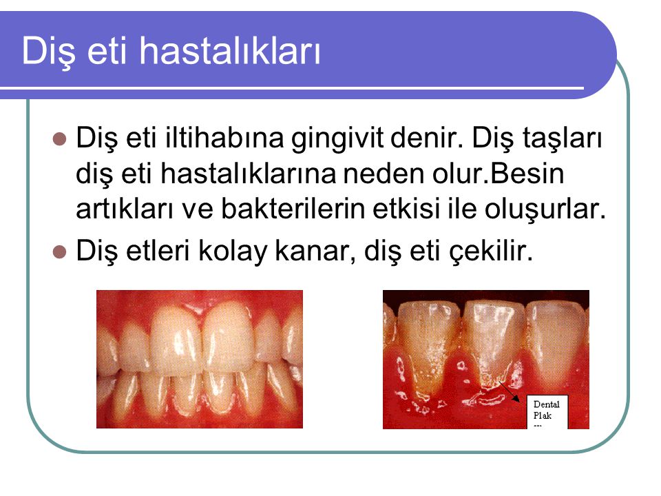 Diş eti hastalıkları
